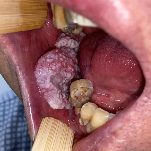 菜牙是什么？菜牙的症状及护理方法