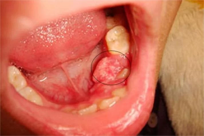 菜牙是什么？菜牙的症状及护理方法