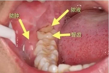嘴里长智齿是拔还是不拔？医生建议是什么？