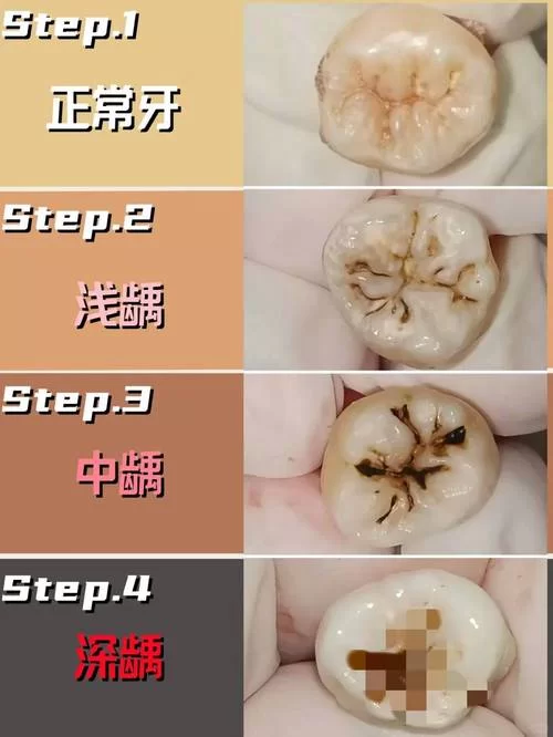 牙齿小白点是龋齿还是其他问题？如何区分？