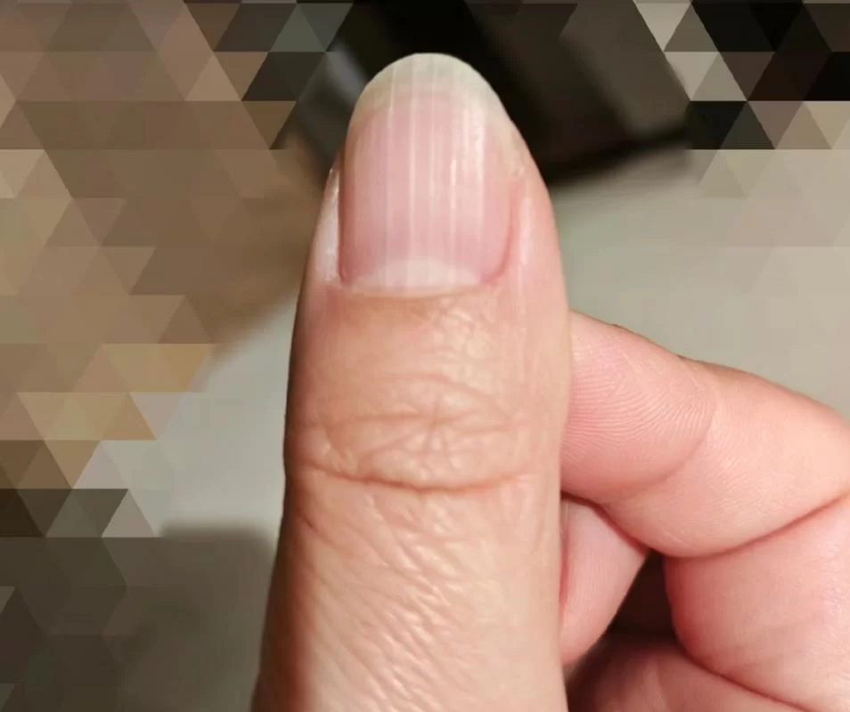 指甲出现竖纹，是严重疾病的预兆吗？看完你就懂了！