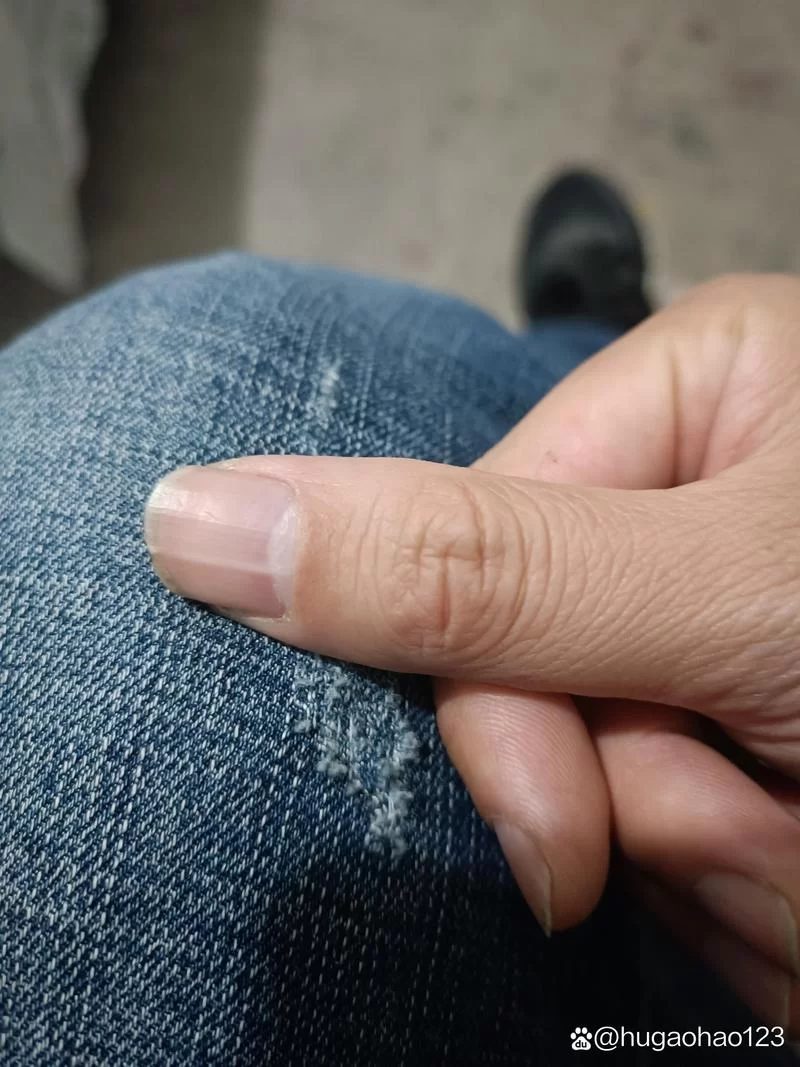 指甲出现竖纹，是严重疾病的预兆吗？看完你就懂了！