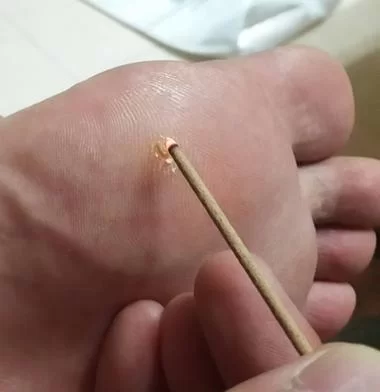 脚上出现小小的鸡眼疼不疼？简单方法快速缓解！