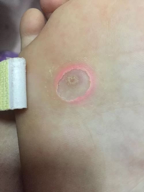 脚上出现小小的鸡眼疼不疼？简单方法快速缓解！
