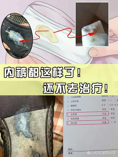 白带异常是咋回事？为啥会流出白色的液体？