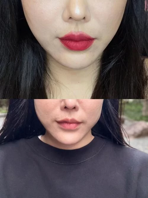 瘦脸要花多少钱？瘦脸针、溶脂针价格差别大不大？