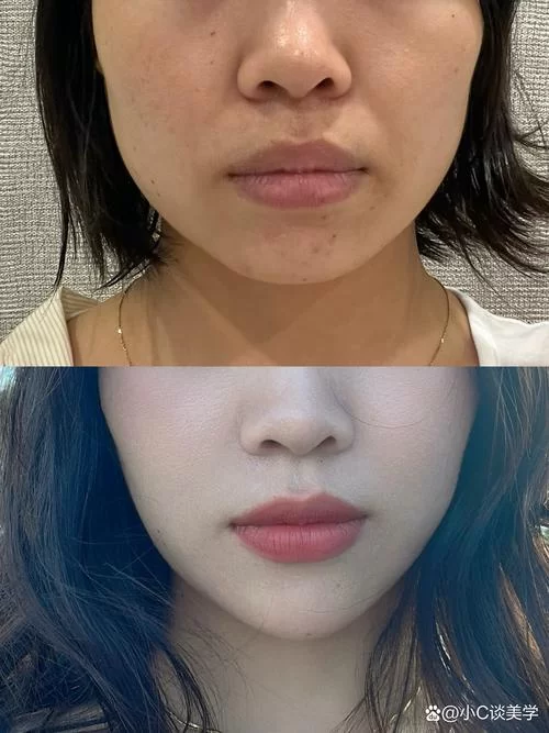瘦脸要花多少钱？瘦脸针、溶脂针价格差别大不大？