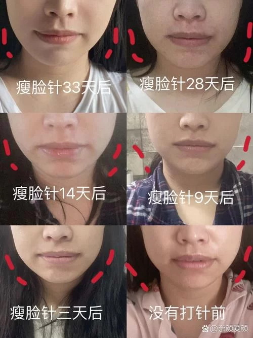瘦脸要花多少钱？瘦脸针、溶脂针价格差别大不大？