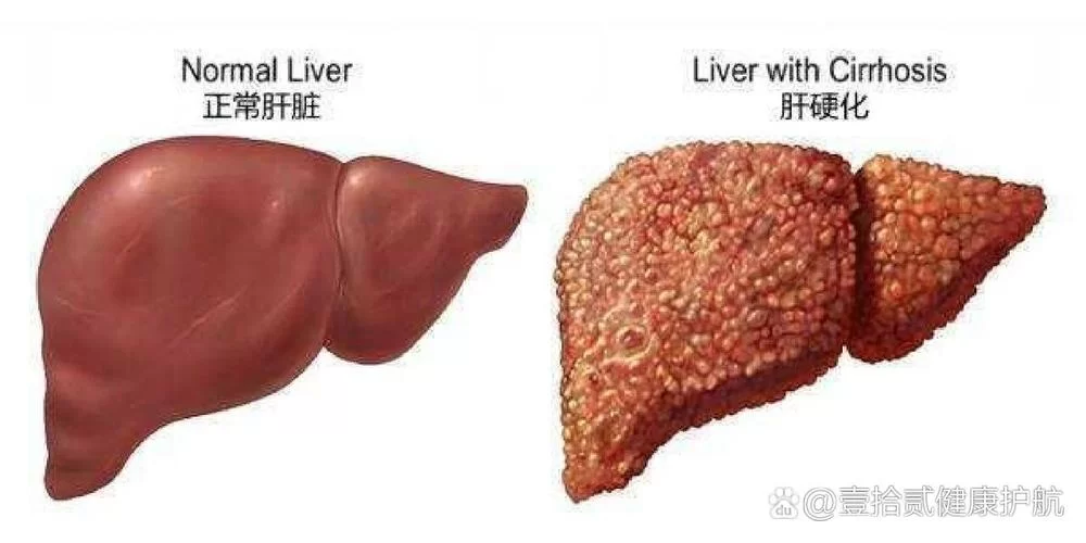 肝硬化F4分级是什么意思？F4肝脏纤维化严重吗
