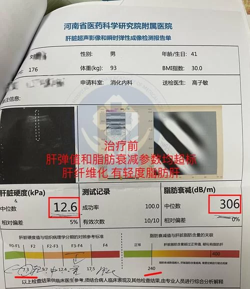 肝硬化F4分级是什么意思？F4肝脏纤维化严重吗