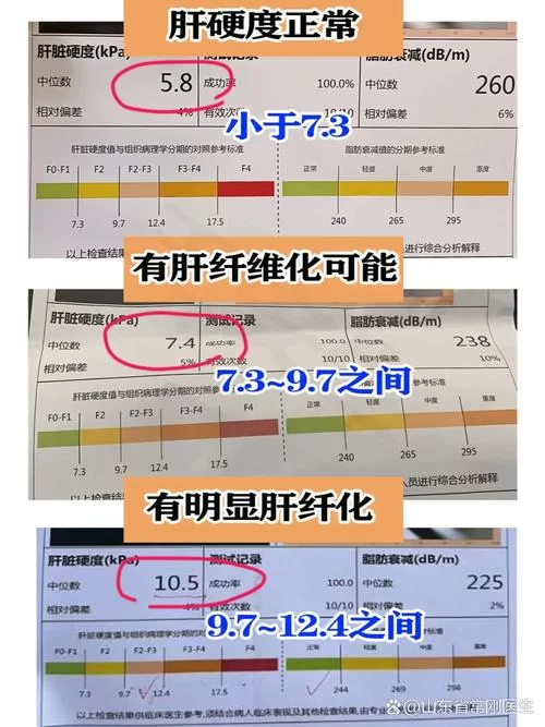 肝硬化F4分级是什么意思？F4肝脏纤维化严重吗