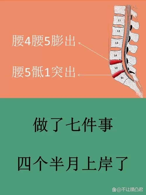 腰椎滑脱要躺多久？100天真的必要吗？