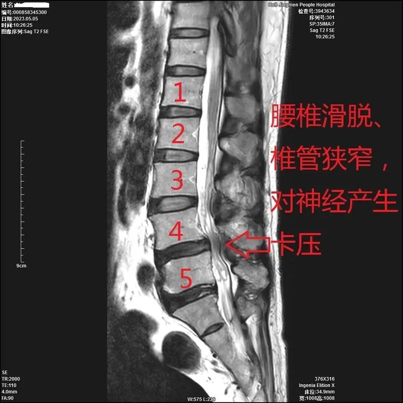 腰椎滑脱要躺多久？100天真的必要吗？