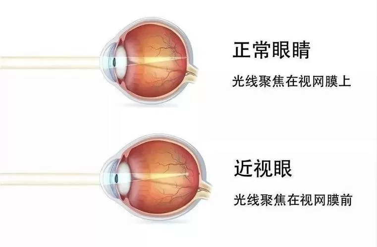蚂蚁庄园每日答题：关于近视镜的那些事儿