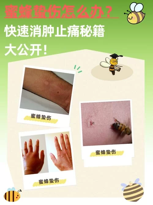 蛰蜂之死：农村地区蜂蛰伤亡事件调查及防治