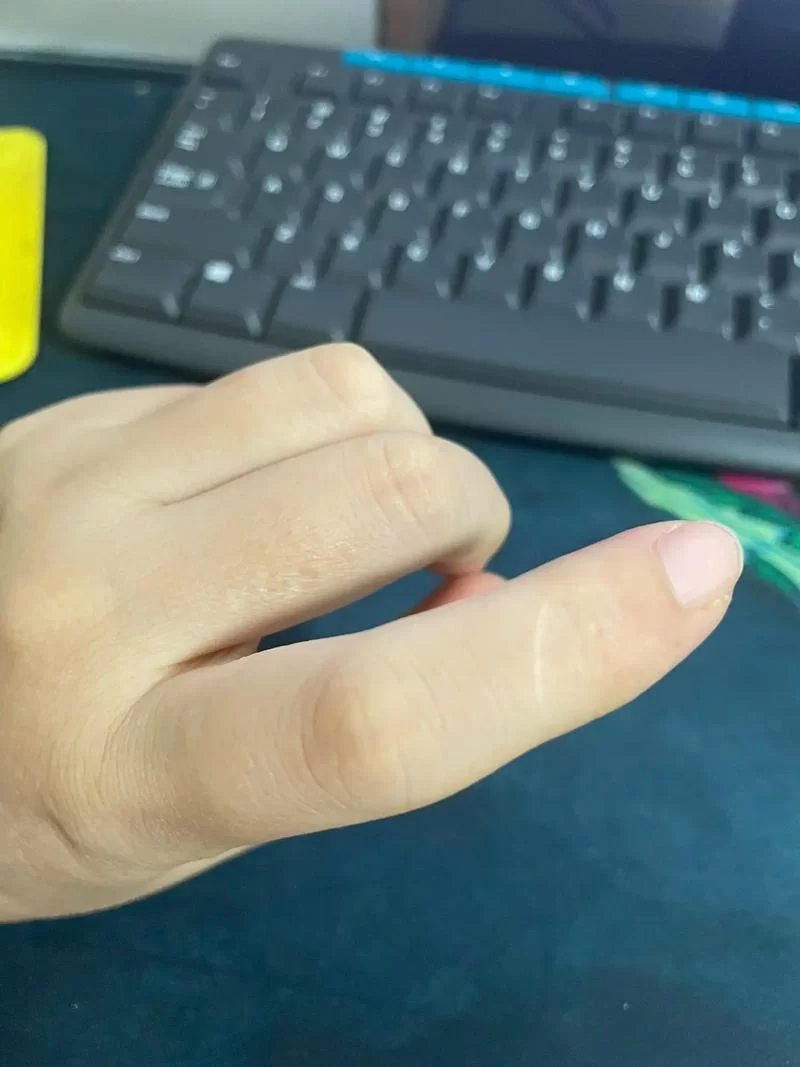 食指有疤痕代表什么？民间说法与科学解释