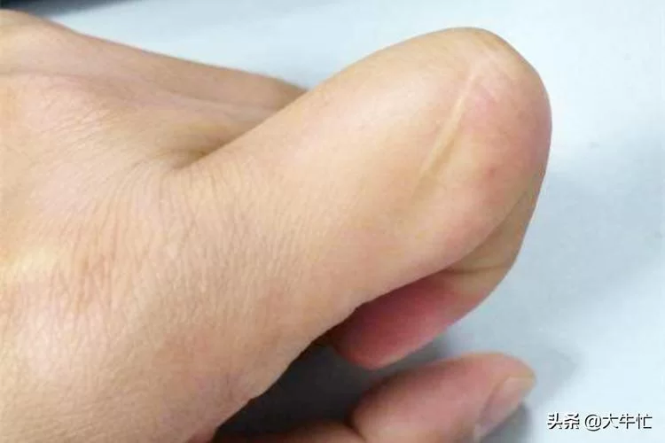 食指有疤痕代表什么？民间说法与科学解释