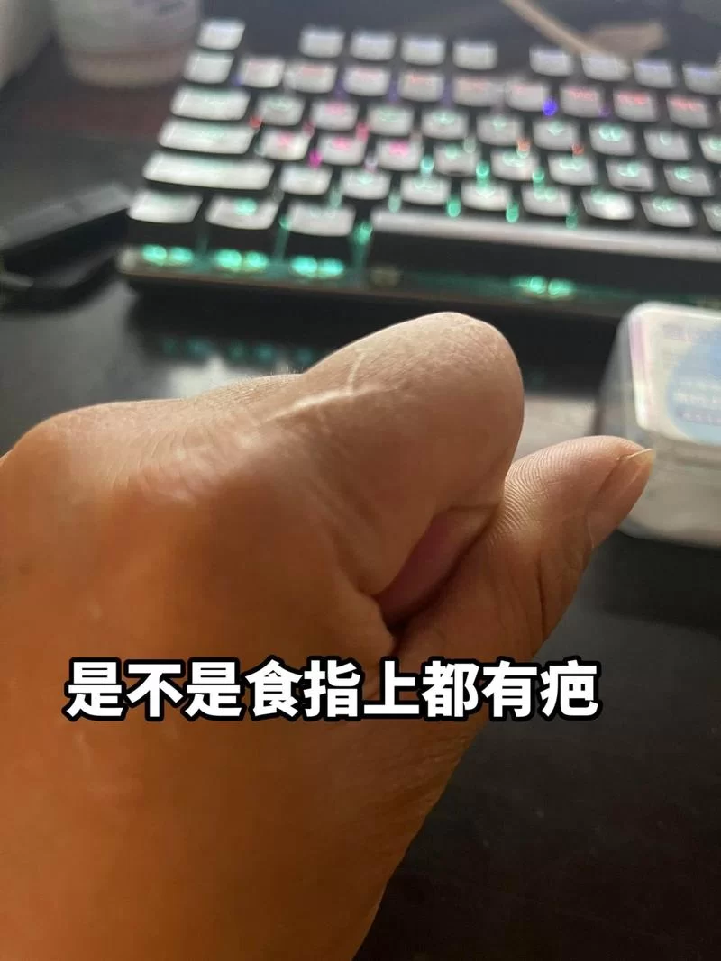 食指有疤痕代表什么？民间说法与科学解释